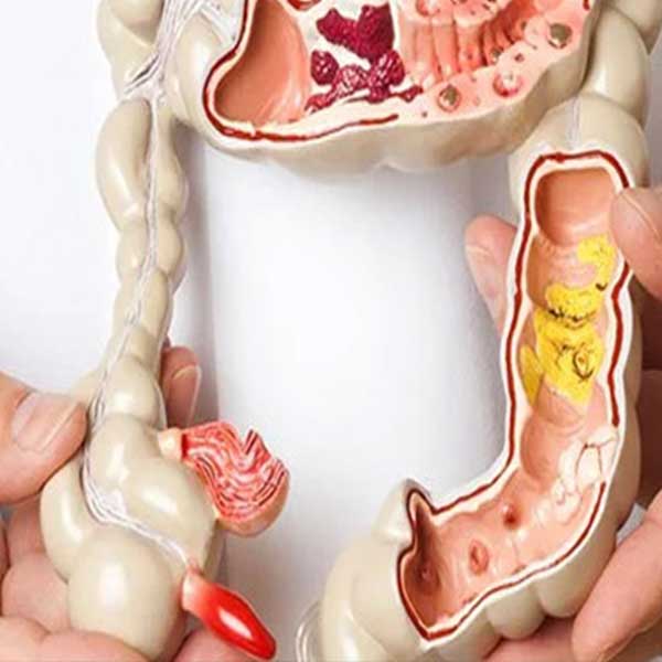 hernia
