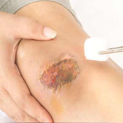 Knee Aliments