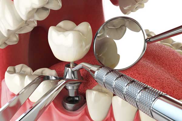 Implant Dentistry