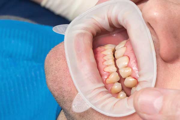 Implant Dentistry