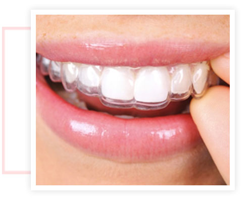 invisalign