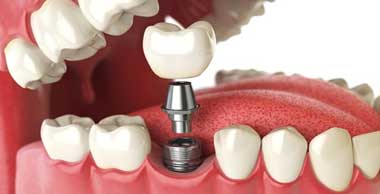 Dental Implant Treatments