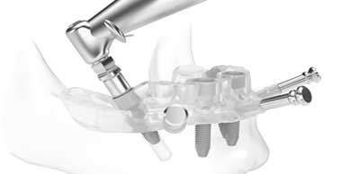Dental Implant Treatments