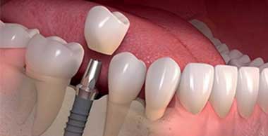 Dental Implant Treatments