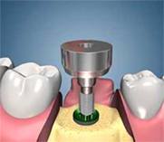 Digital Dental Implants