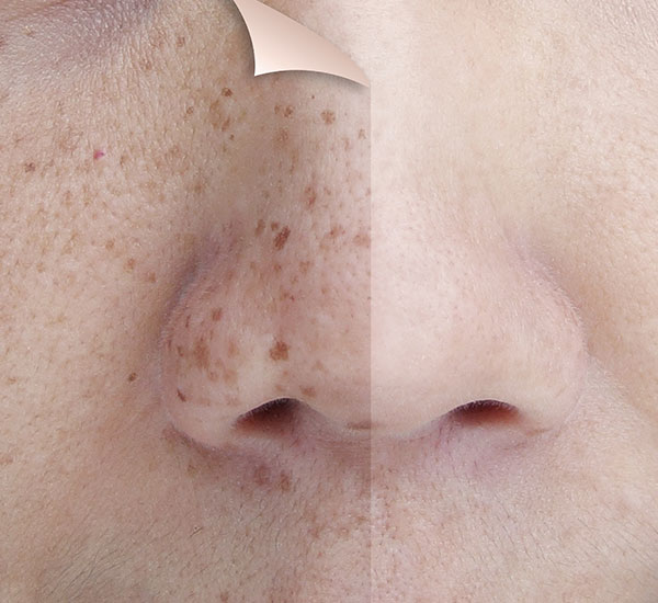skin