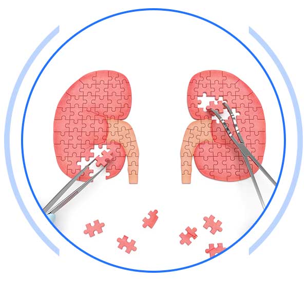 Kidney Transplant