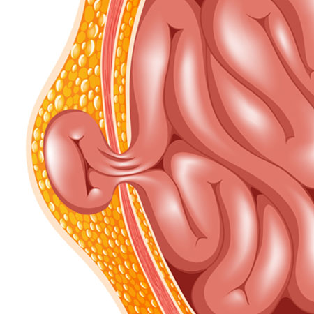 hernia