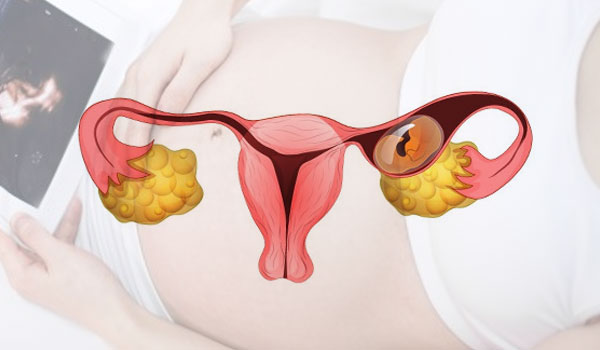 laparoscopy
