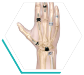  joint replacement