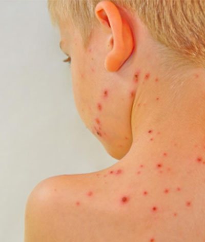 Laser Dermatology