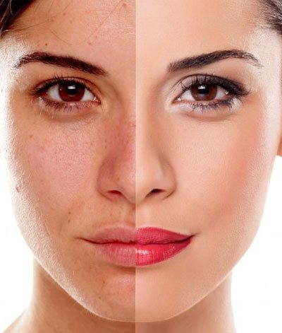 Laser Dermatology